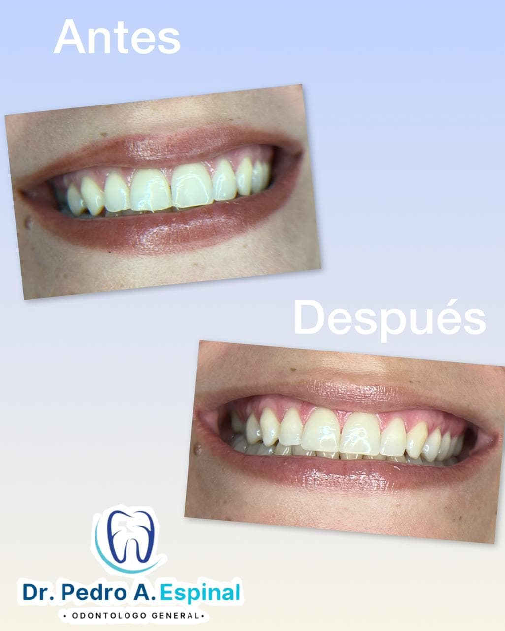 Diseño de sonrisa