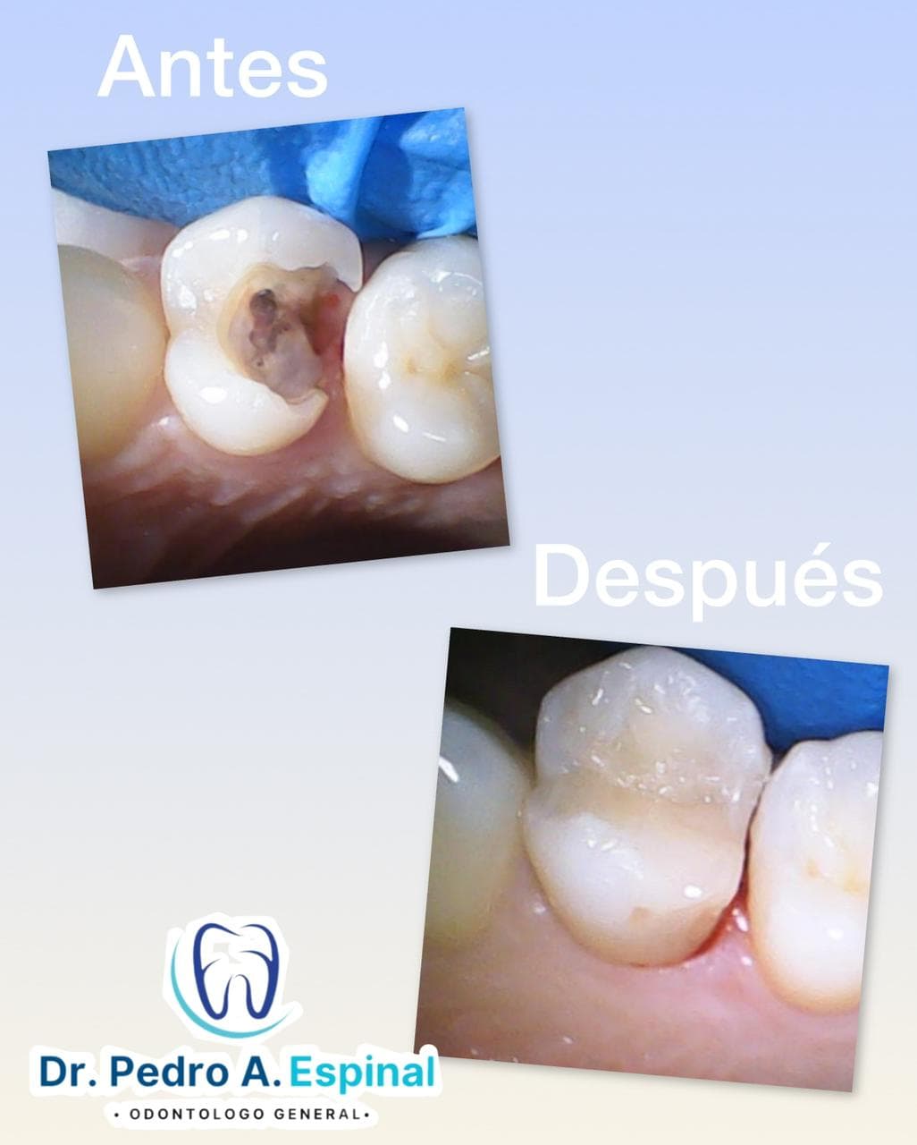 Restauración dental