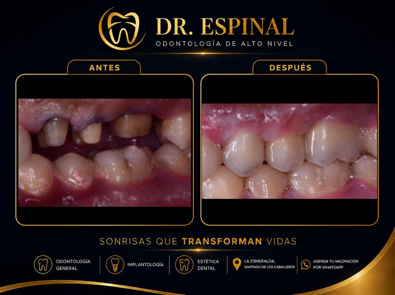 Implantes dentales