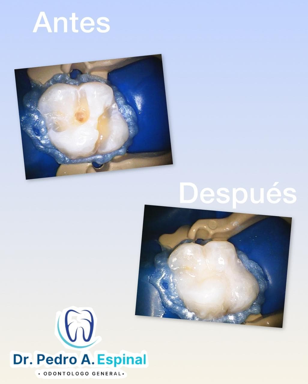 Restauración dental