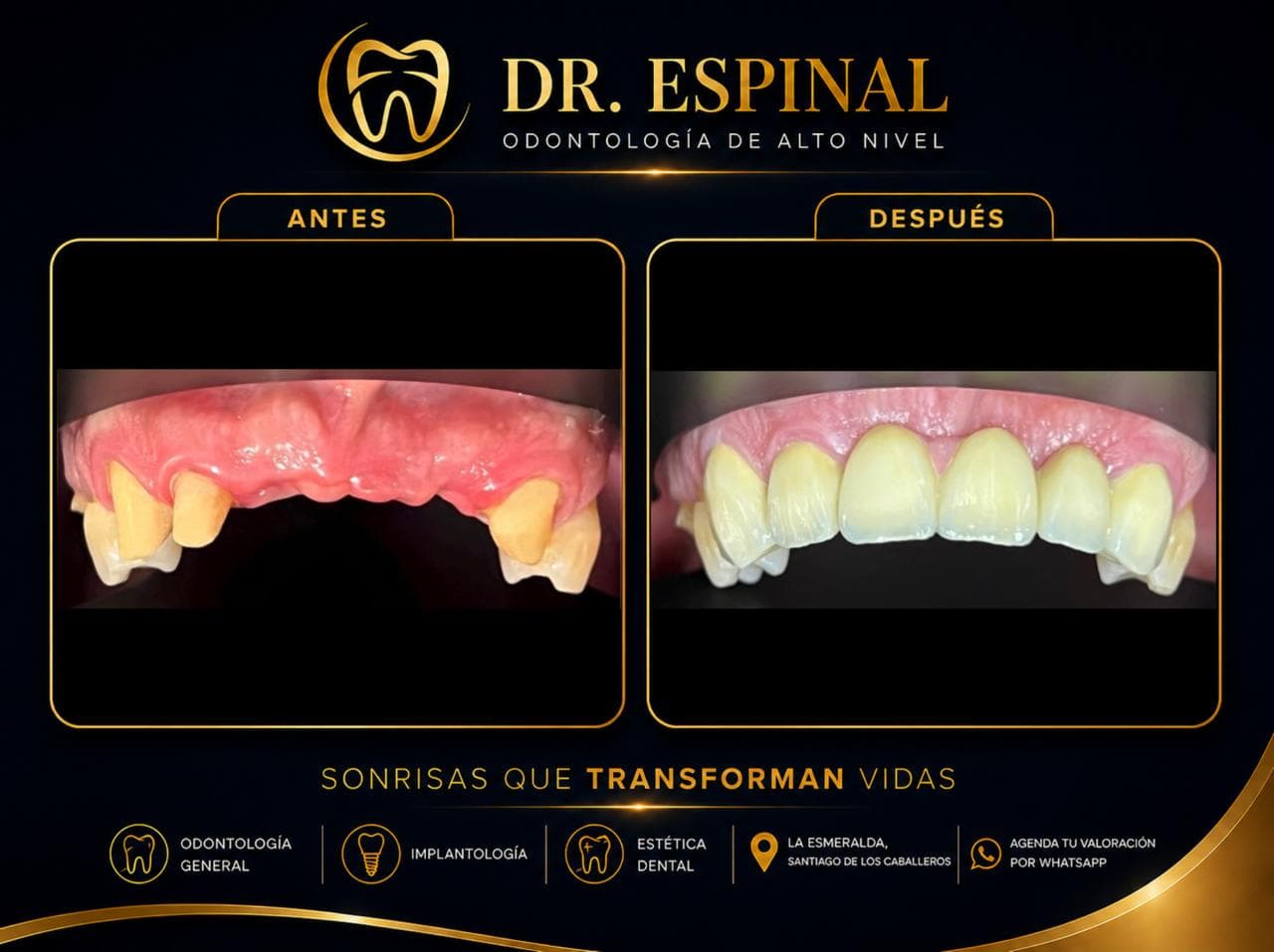 Implantes y coronas
