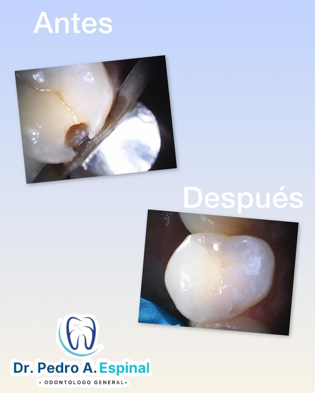 Restauración dental