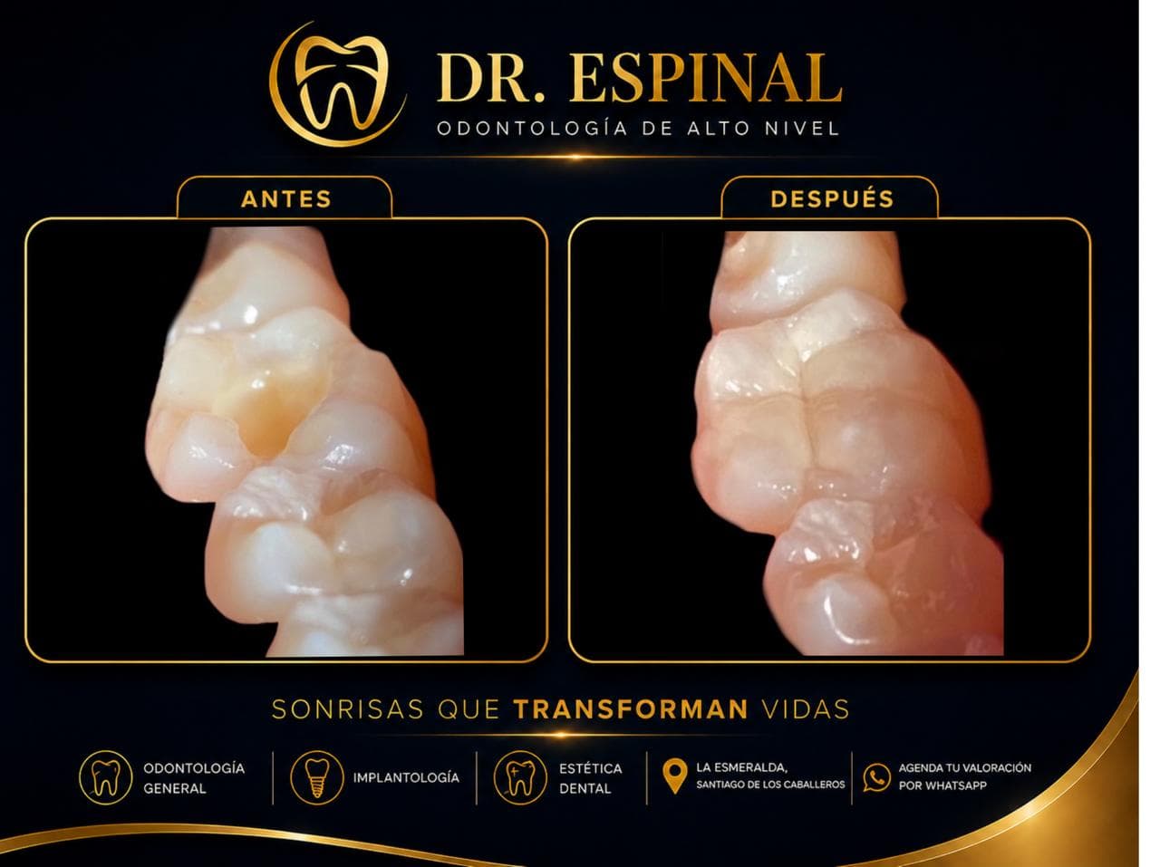Restauración molar