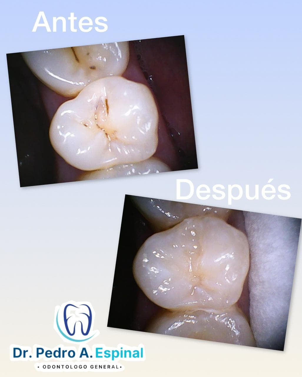 Restauración dental