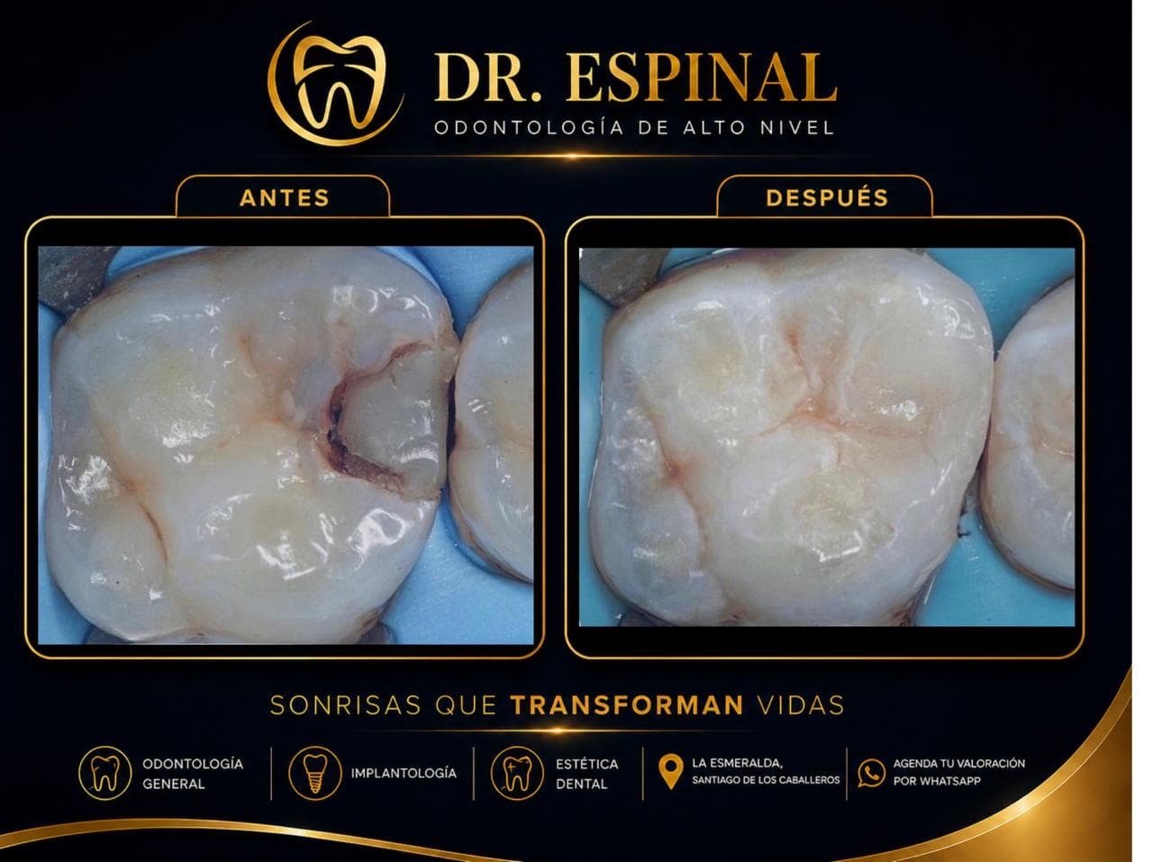 Restauración dental
