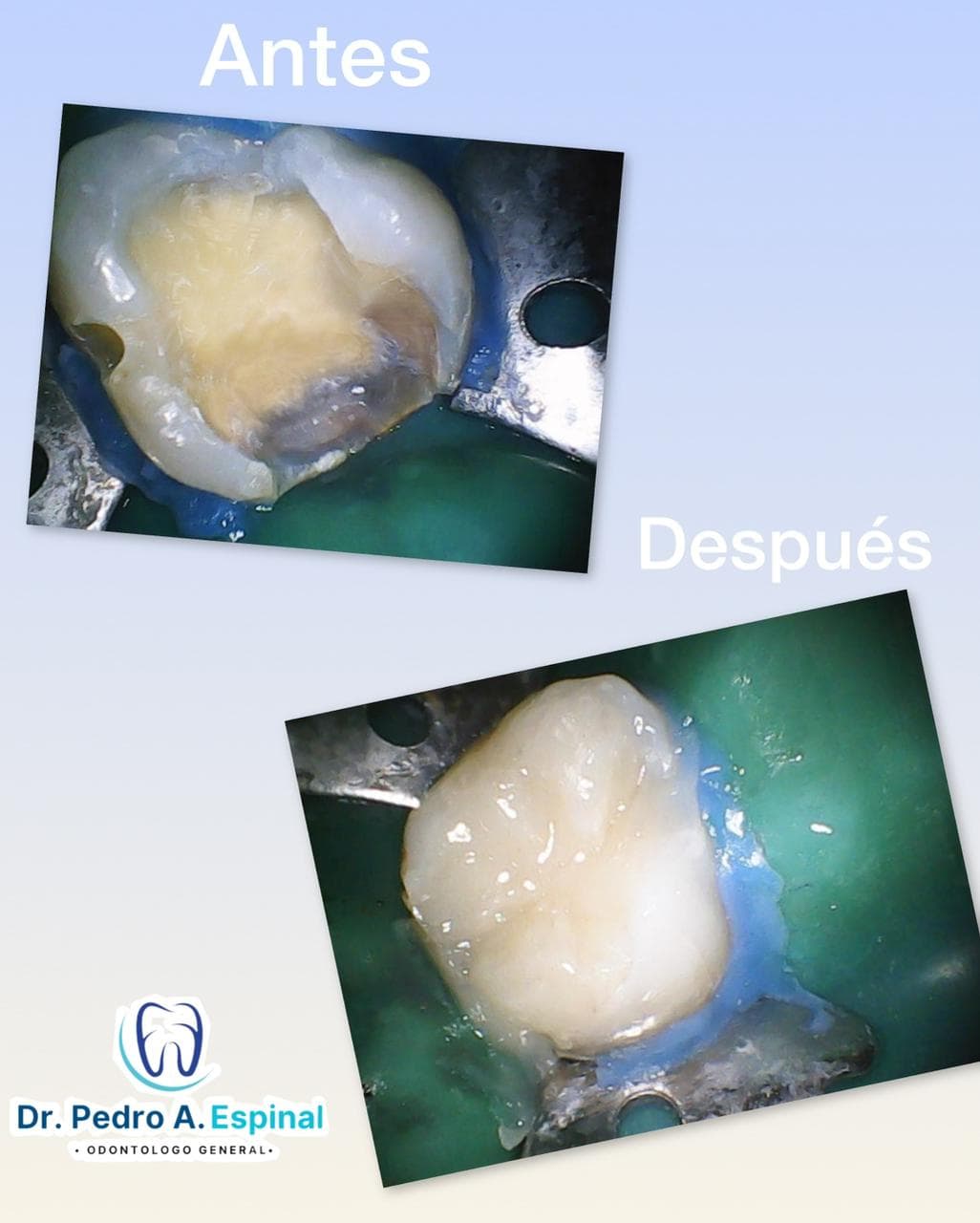 Restauración dental
