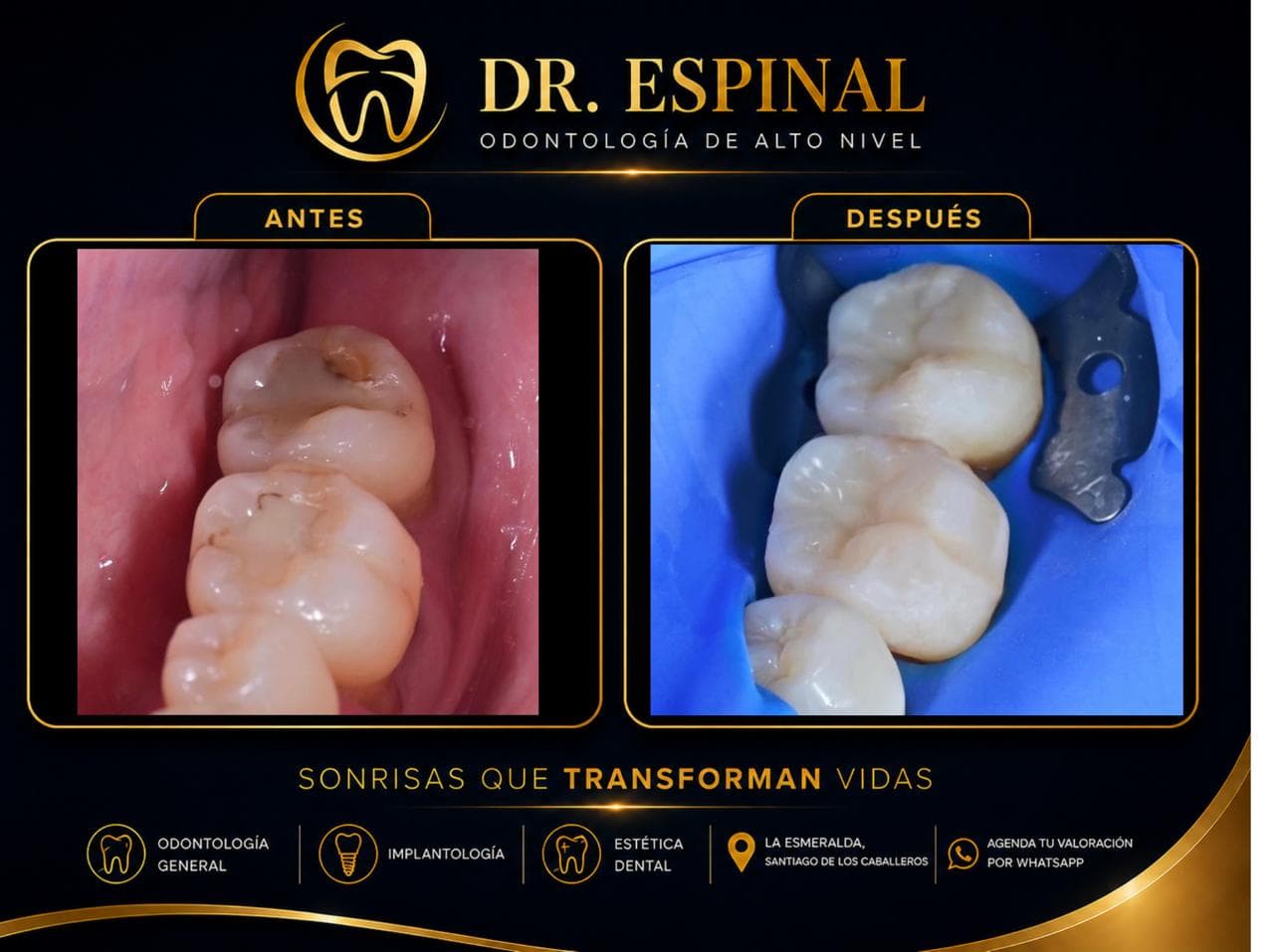 Restauración dental