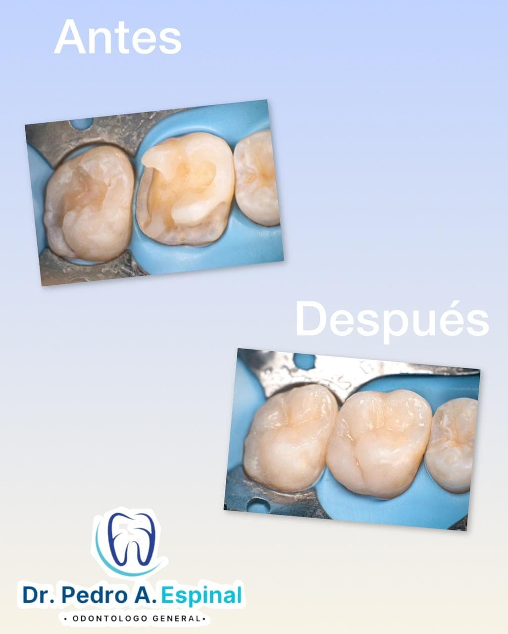 Restauración dental
