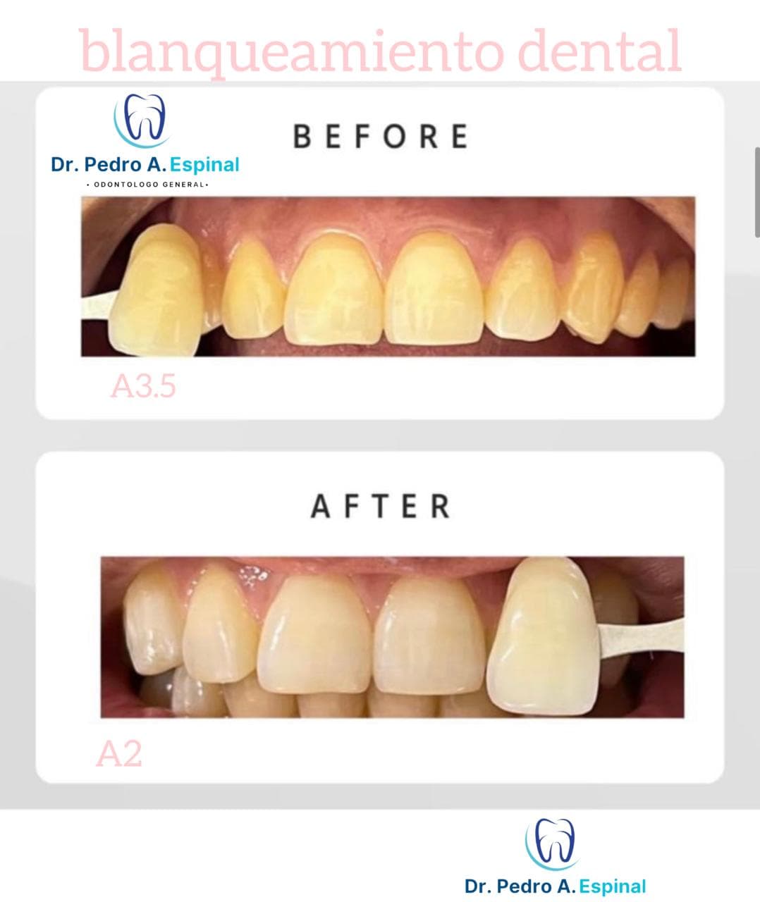 Blanqueamiento dental