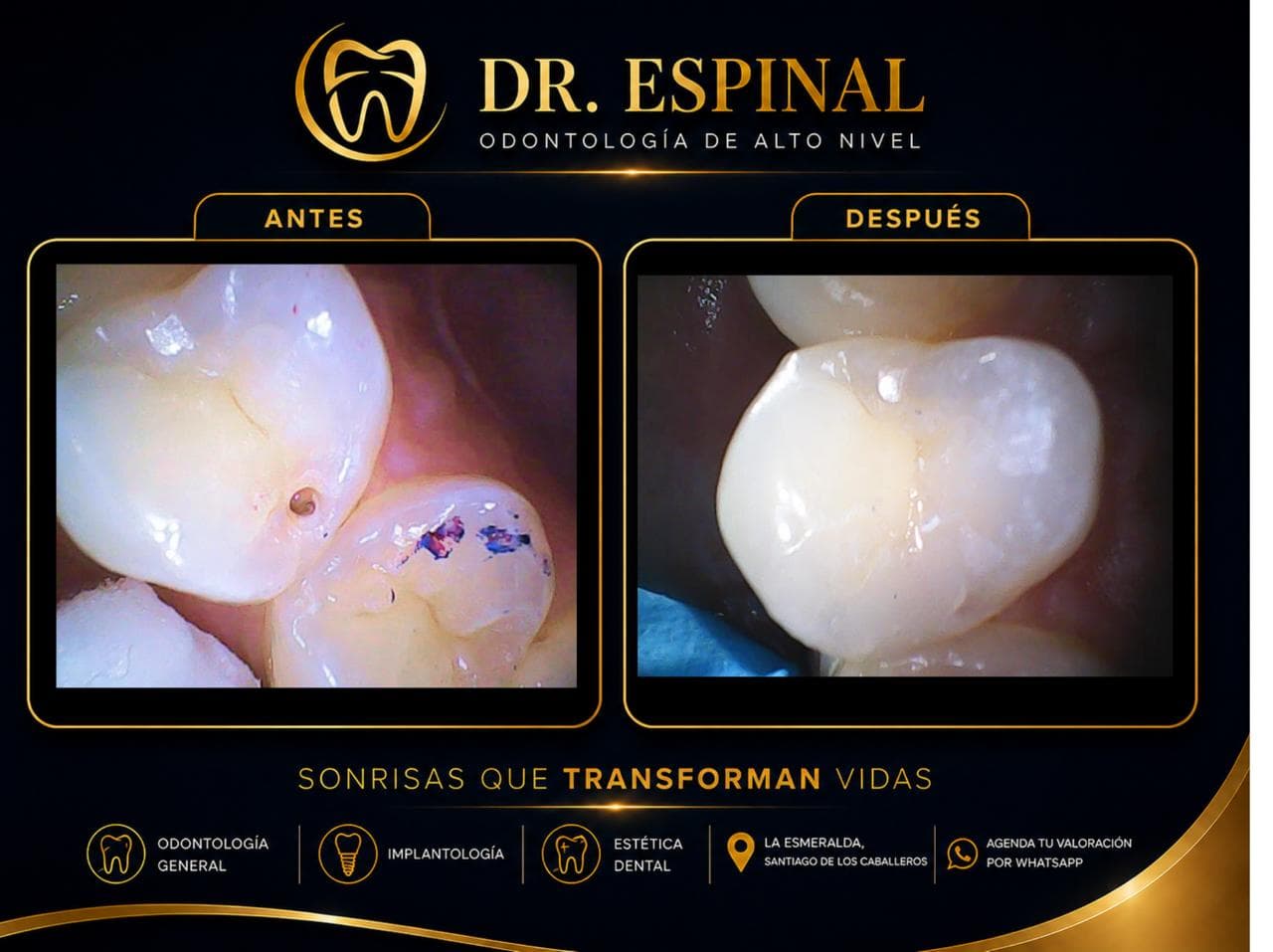 Restauración dental