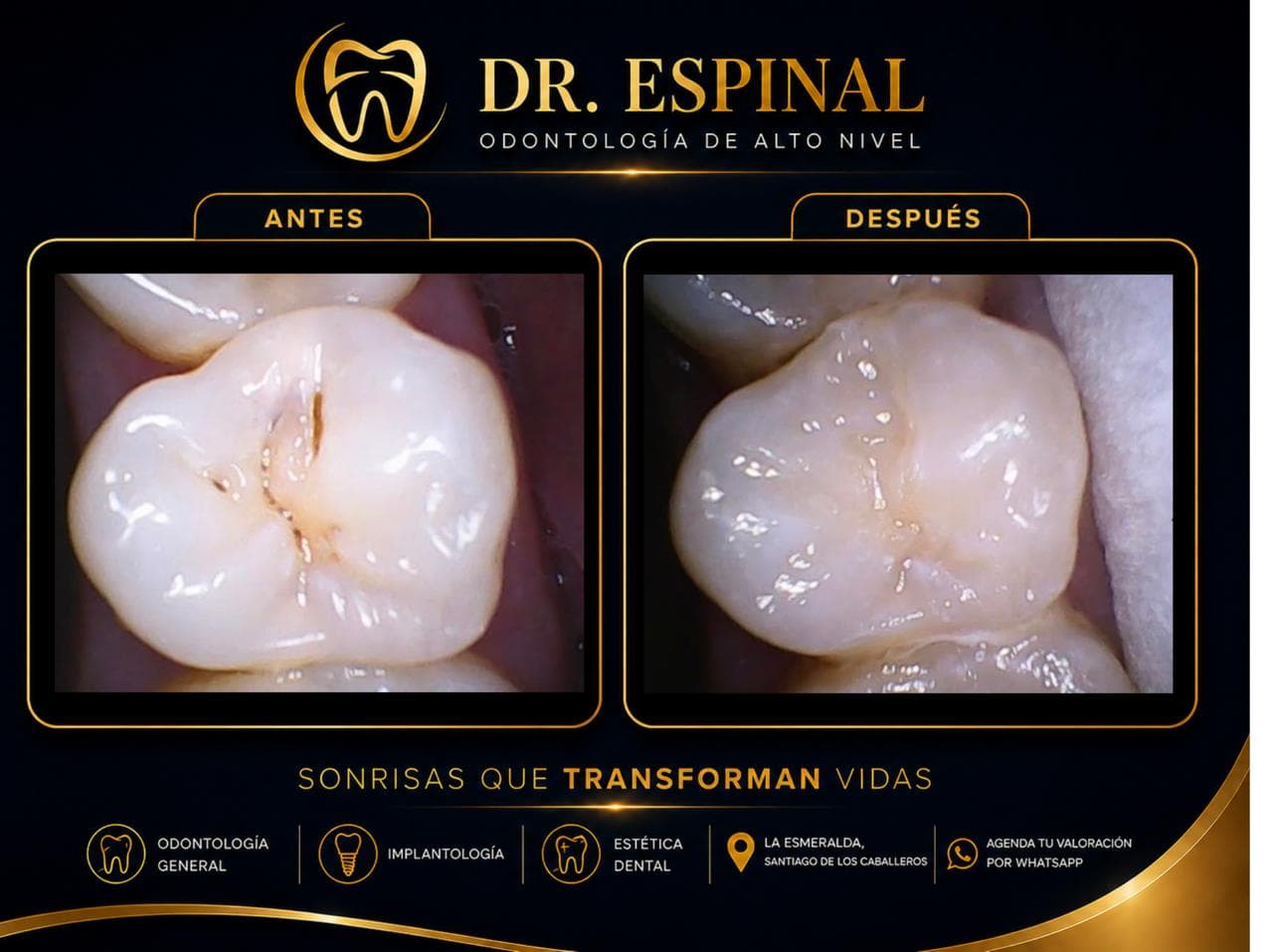 Restauración dental
