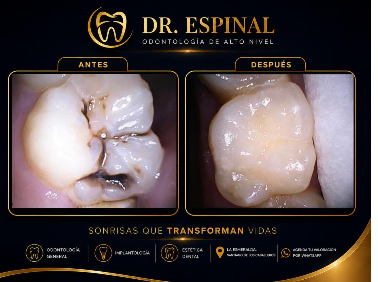 Implantes dentales