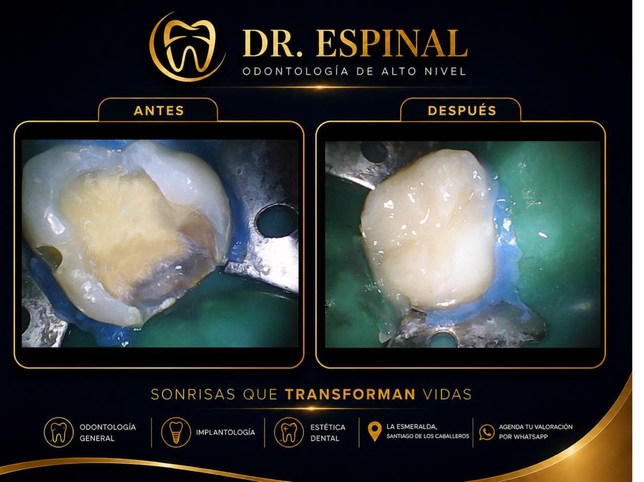 Restauración dental
