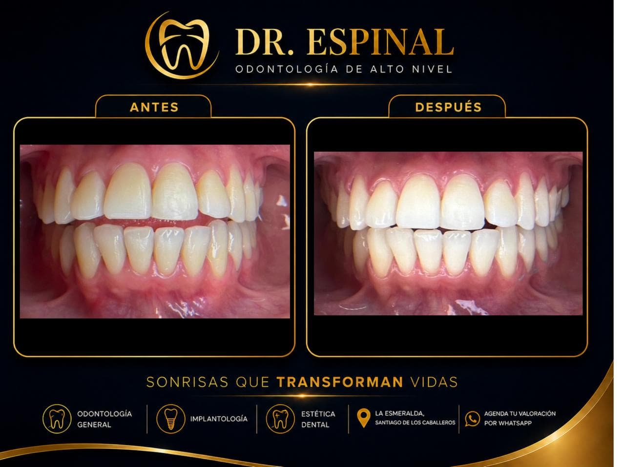 Blanqueamiento dental