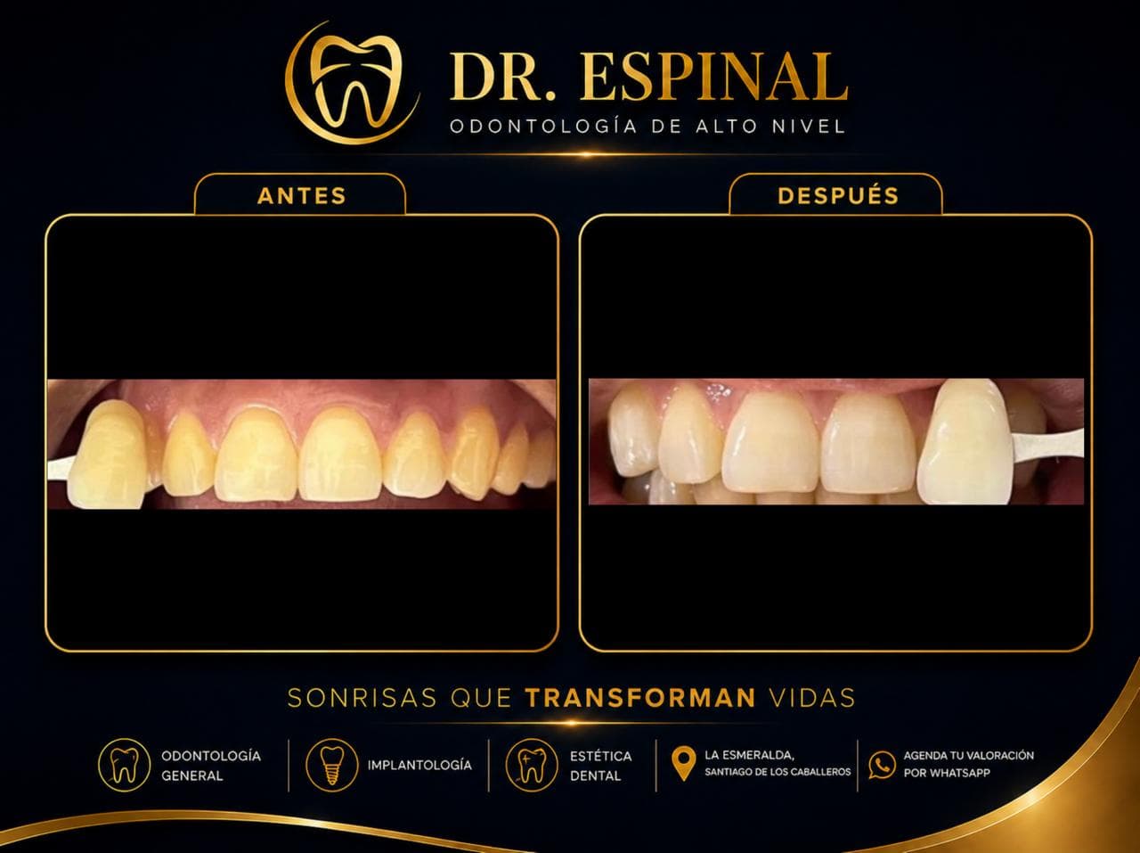 Blanqueamiento dental