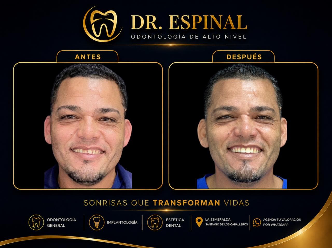 Implantes dentales